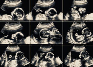 Ultrasonography