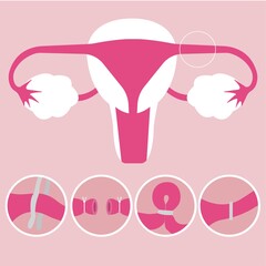 CONTRACEPTION