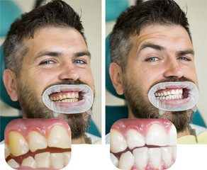 Best Teeth Whitening Product 2023