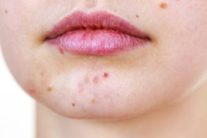 Best Cleansers For Acne Prone Skin