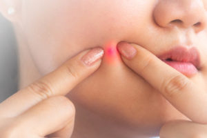 Best Cleansers for Acne Prone Skin