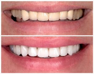 What is the Most Effective Home Teeth Whitening Product?