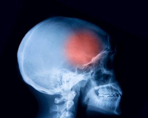 Migraines: How Common Are They and How to Treat Them