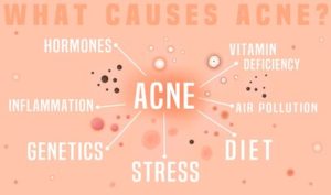 Best Cleansers For Acne Prone Skin