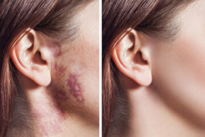 Removal Of Facial Birthmarks