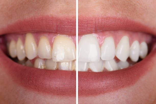 Best Teeth Whitening Gum