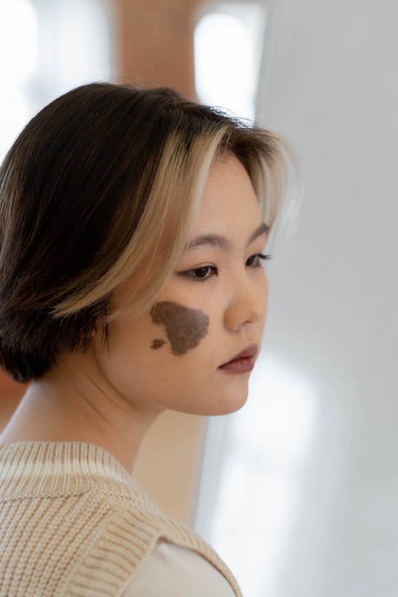 Removal Of Facial Birthmarks